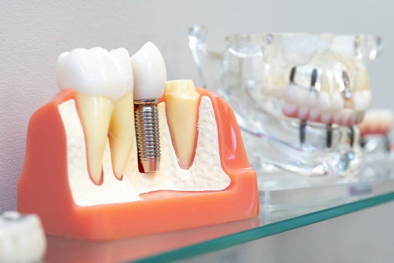 Unpacking Dental Implants: What’s an Implant, How It Works, and Its Lasting Benefits