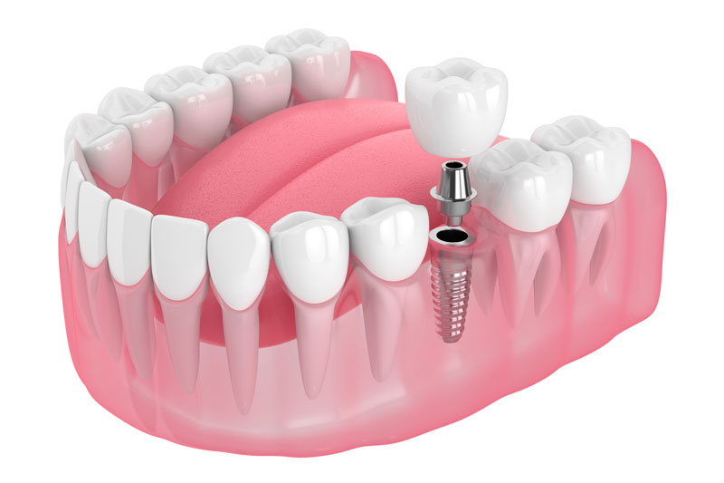 A 3D rendering of a dental implant in a pink gum model, showing a metal screw with an abutment and crown, illustrating the replacement of a single missing tooth. A 3D rendering of a dental implant in a pink gum model, showing a metal screw with an abutment and crown, illustrating the replacement of a single missing tooth