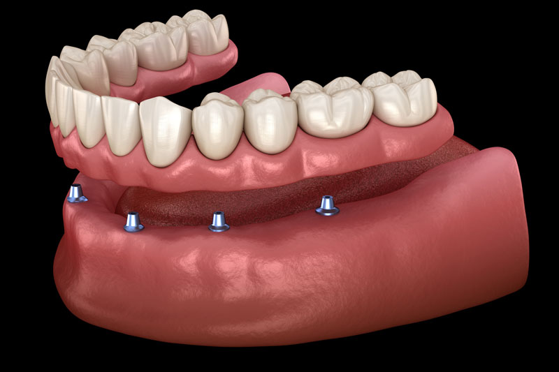 all on 4 implant supported dentures 3d model black background