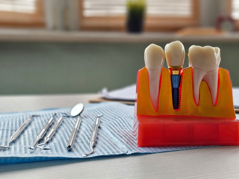Detailed Dental Implant Review: Discover Procedures, Benefits & Long-Term Care