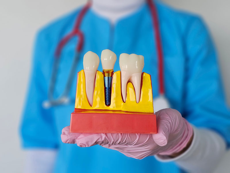 Dental Implants Review: Expert Insights and Essential Considerations for a Lasting Smile